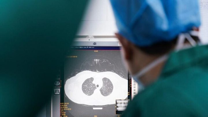 Asymptomatic coronavirus patients’ lungs could be damaged