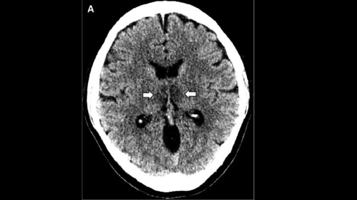 Woman diagnosed With COVID-19 develops rare brain disease